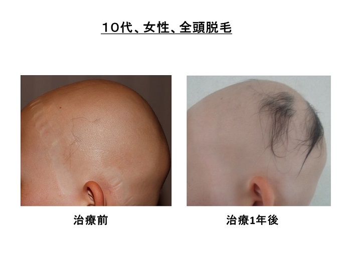 円形脱毛症　病院